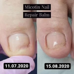 Micotin Nail Repair Balm: восстановление ногтя за месяц (фото)