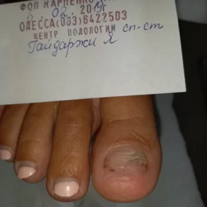 Micotin Nail Repair Balm: восстановление ногтя с нуля (фото)